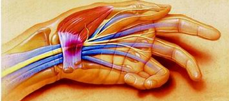 SINDROME DEL TUNNEL CARPALE